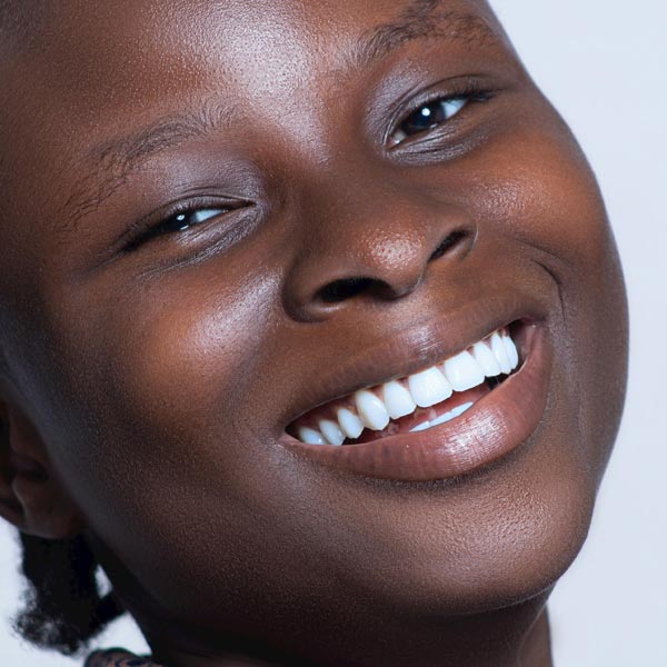 Dream Smile Dental - Inlays - Onlays