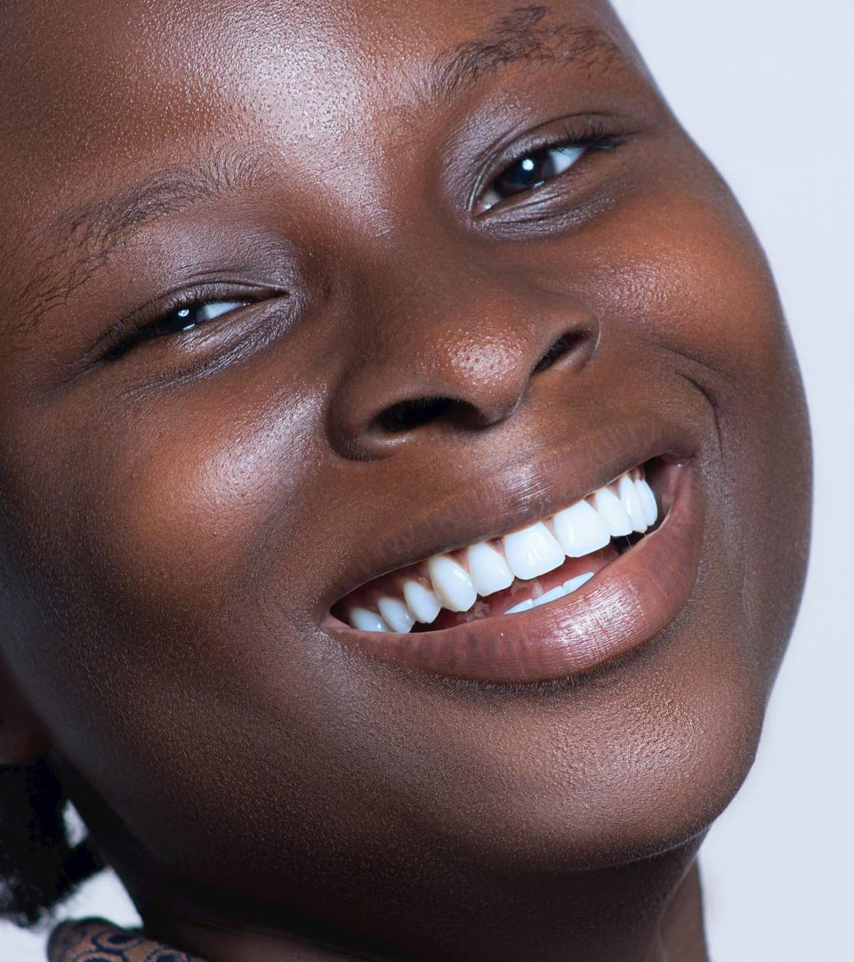 Dream Smile Dental - Inlays - Onlays