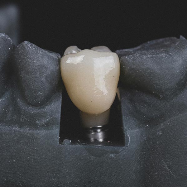 Dream Smile Dental - Why Choose Dental Implants