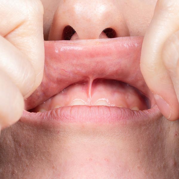 Dream Smile Dental - Why Choose Frenectomy