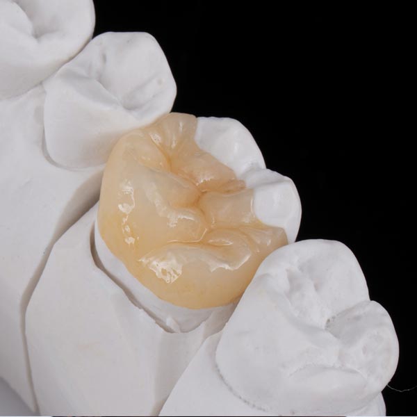 Dream Smile Dental - Why Choose Inlays - Onlays