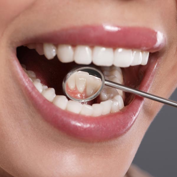 Dream Smile Dental - Why Choose Tooth Coloured Fillings