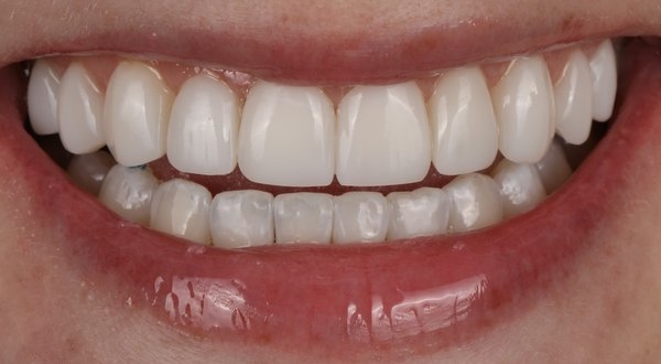 Dream Smile Dental - Composite Bonding Patient After