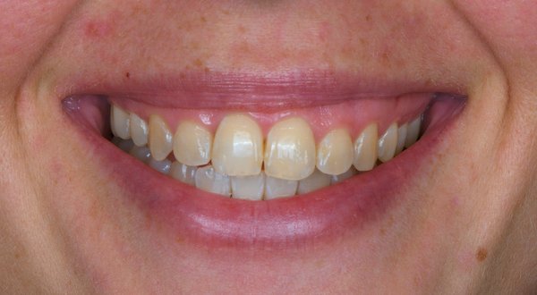 Dream Smile Dental - Laser Gum Contouring Patient Before