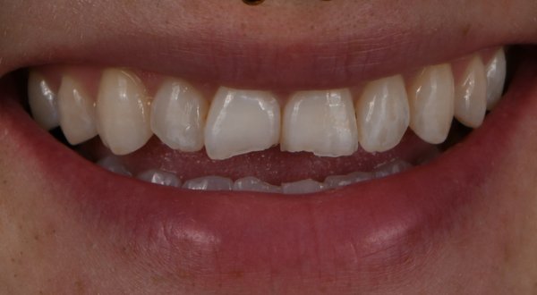 Dream Smile Dental - Composite Bonding Patient Before