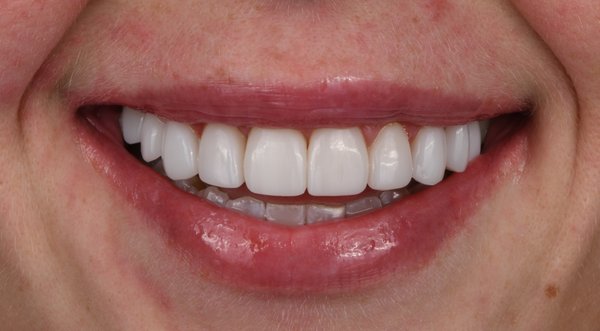 Dream Smile Dental - Laser Gum Contouring Patient After