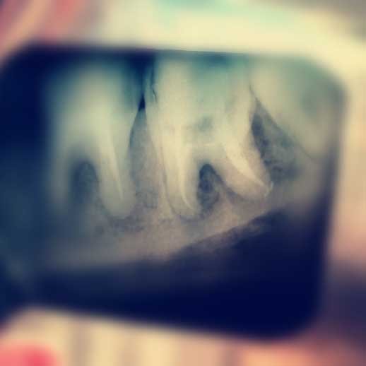 Dream Smile Dental - Root Canal Exclusion