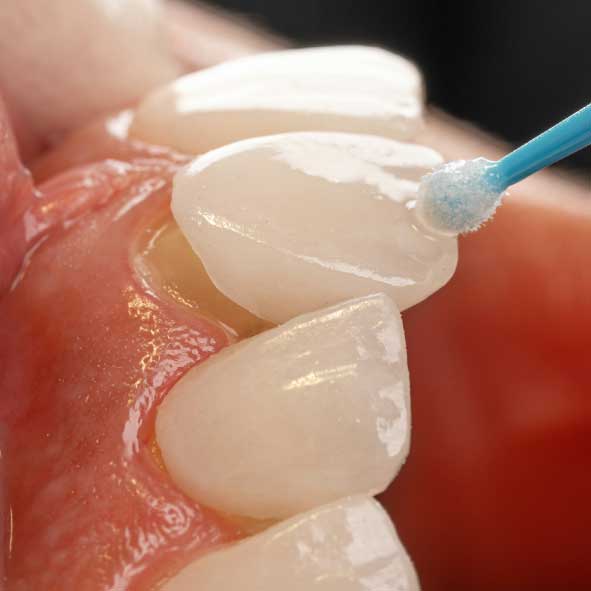 Dream Smile Dental - Veneer Application