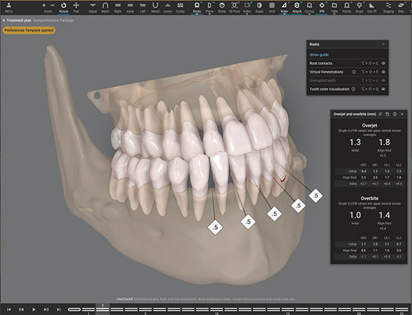 Dream Smile Dental - Invisalign Journey