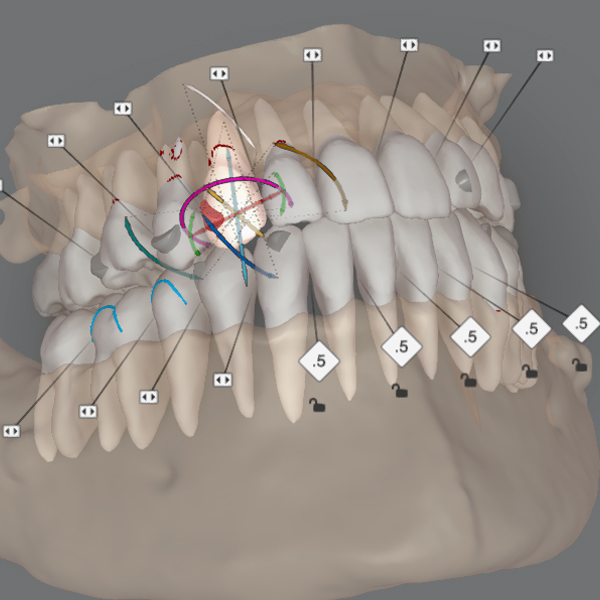 Dream Smile Dental - Invisalign Journey