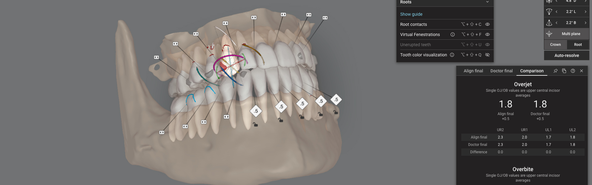Dream Smile Dental - Invisalign Journey