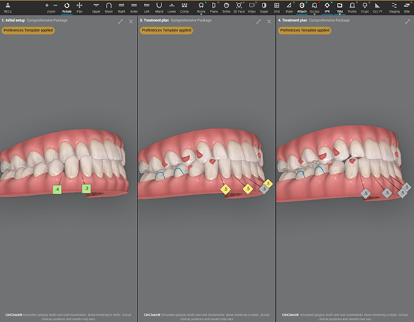 Dream Smile Dental - Invisalign Journey
