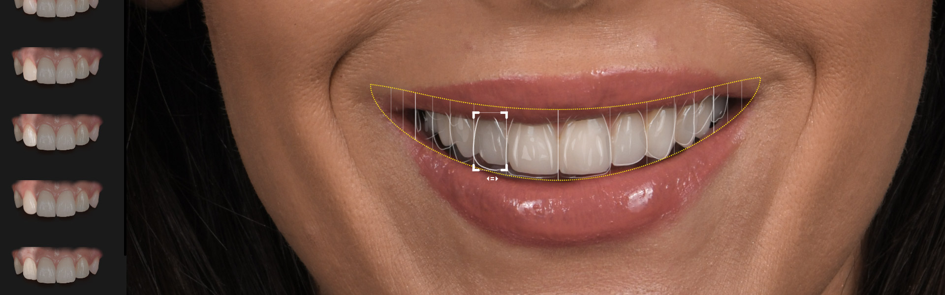 Dream Smile Dental - Smile Makeover