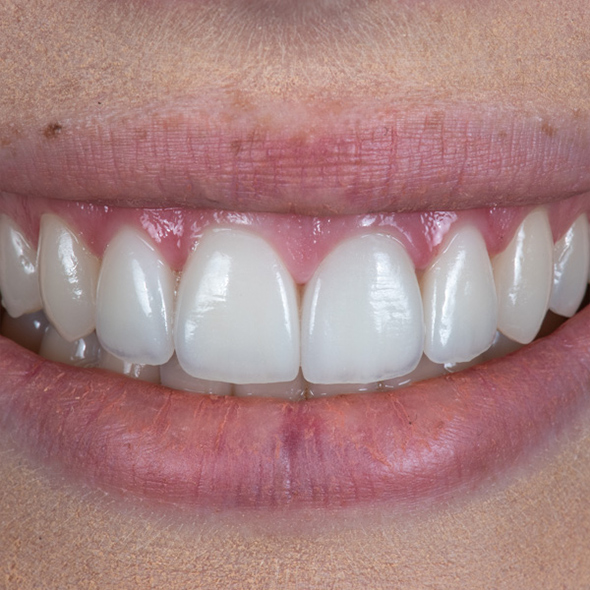 Dream Smile Dental - Smile Makeover