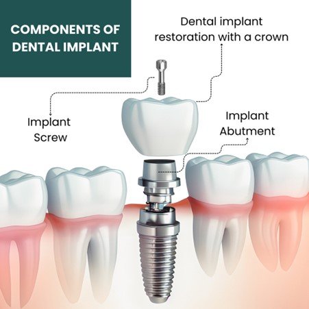 Dream Smile Dental - Final Placement of the Crown
