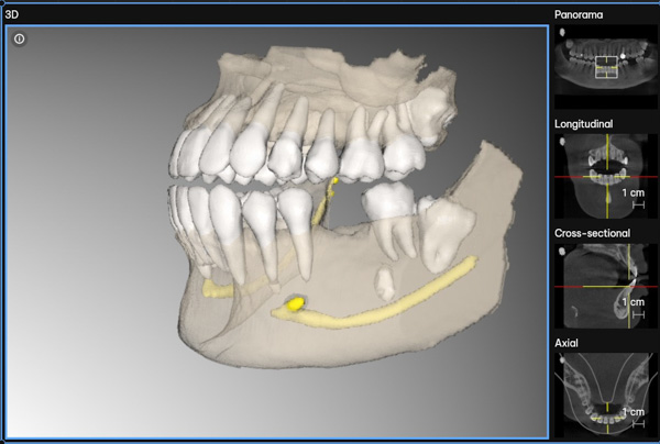 Dream Smile Dental - Comprehensive Implant Assessment