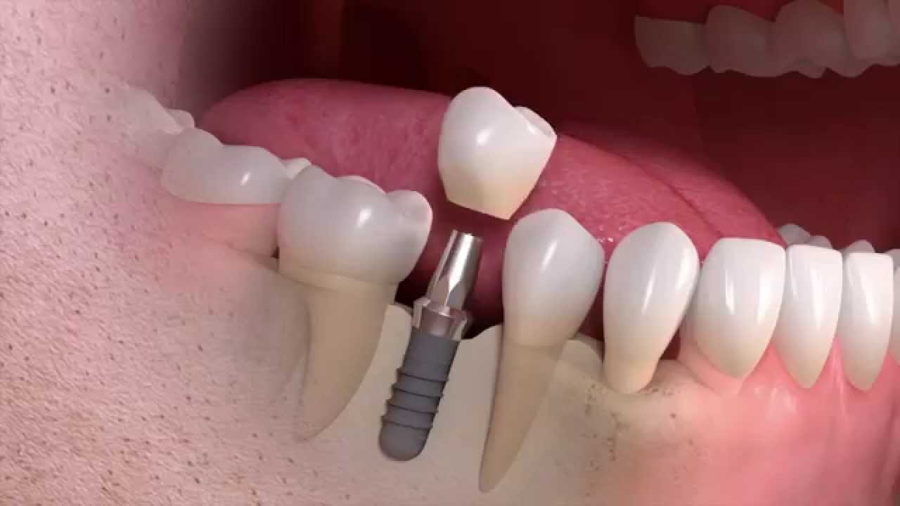 Dream Smile Dental - Healing Process and Temporary Solutions