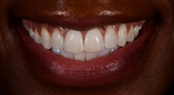 Dream Smile Dental - Invisalign Patient After