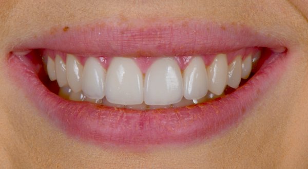 Dream Smile Dental - Cosmetic Dentistry Patient After