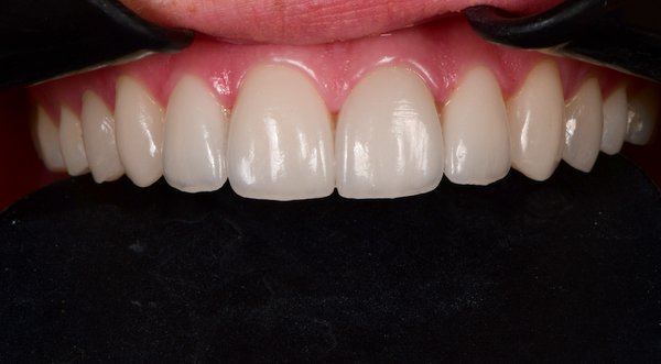 Dream Smile Dental - Cosmetic Dentistry Patient After