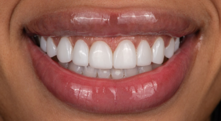 Dream Smile Dental - Laser Gum Contouring / Composite bonding Patient After