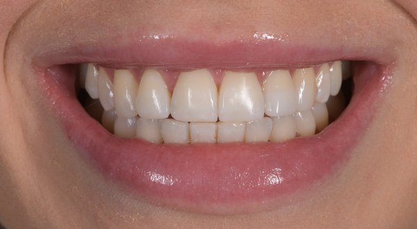 Dream Smile Dental - Invisalign Patient After
