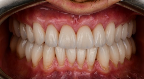 Dream Smile Dental - Cosmetic Dentistry Patient After