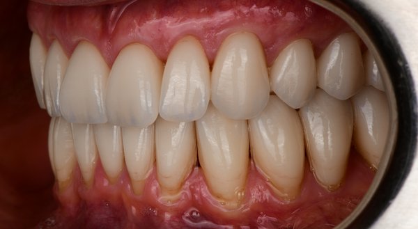 Dream Smile Dental - Cosmetic Dentistry Patient After