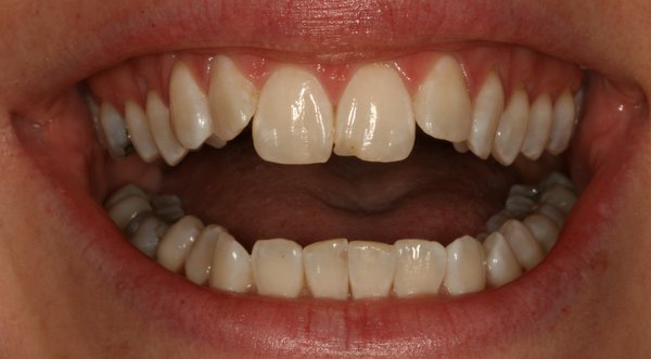 Dream Smile Dental - Invisalign Patient Before