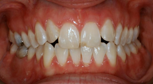 Dream Smile Dental - Invisalign Patient Before