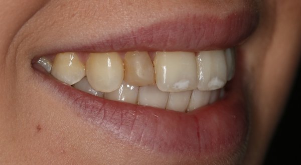 Dream Smile Dental - General Dentistry Patient Before