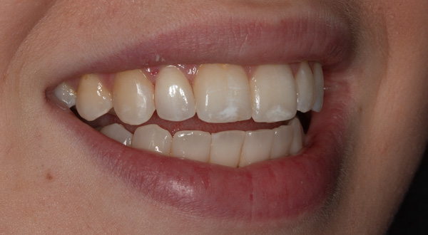 Dream Smile Dental - General Dentistry Patient After