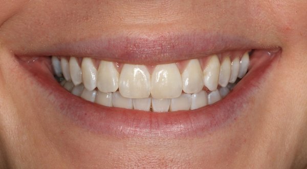 Dream Smile Dental - Invisalign Patient After