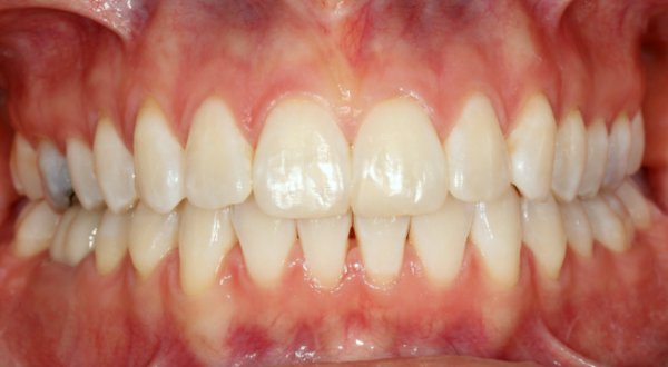 Dream Smile Dental - Invisalign Patient After