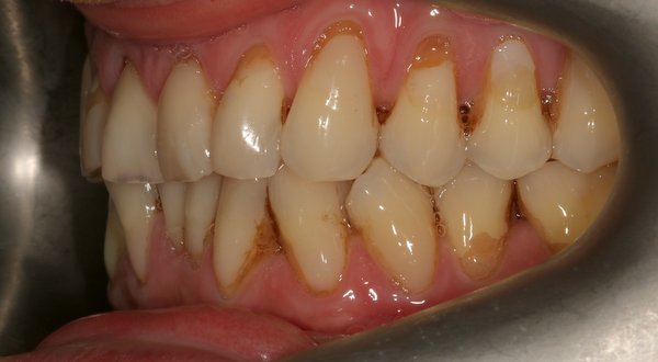 Dream Smile Dental - Cosmetic Dentistry Patient Before