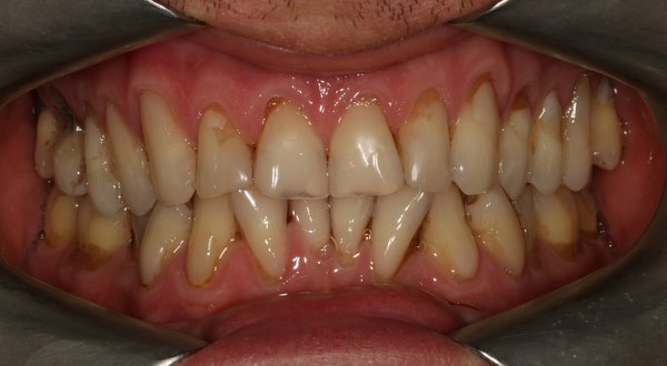 Dream Smile Dental - Cosmetic Dentistry Patient Before