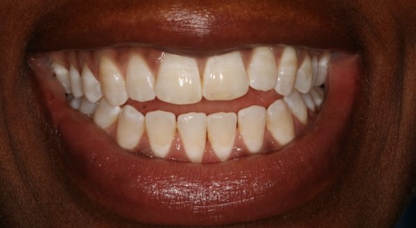 Dream Smile Dental - Invisalign Patient Before