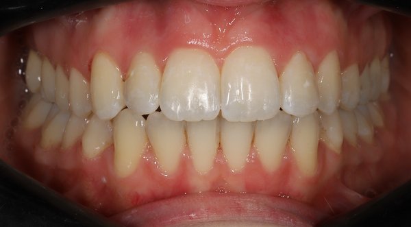 Dream Smile Dental - Invisalign Patient After