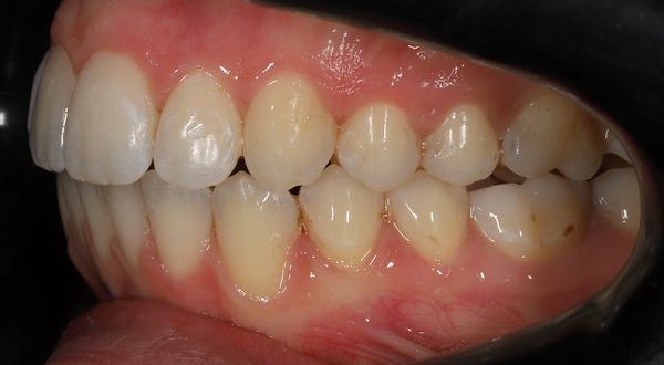 Dream Smile Dental - Invisalign Patient After