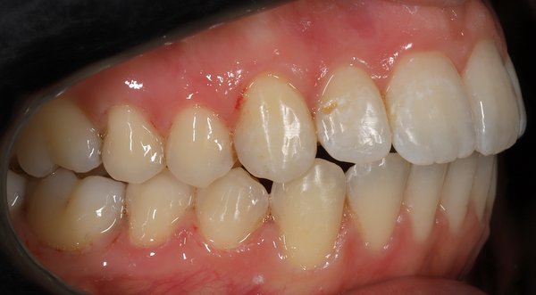Dream Smile Dental - Invisalign Patient After