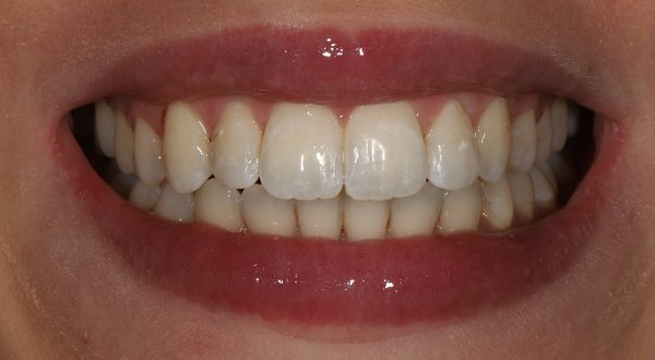 Dream Smile Dental - Invisalign Patient After