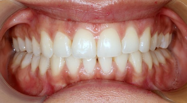 Dream Smile Dental - Invisalign Patient After