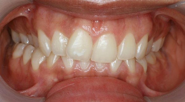 Dream Smile Dental - Invisalign Patient Before