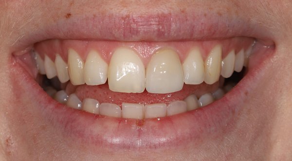 Dream Smile Dental - Cosmetic Dentistry Patient Before