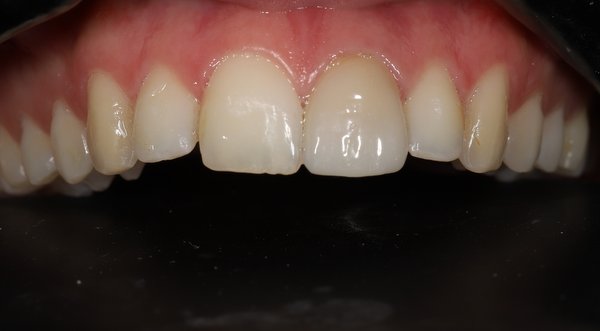 Dream Smile Dental - Cosmetic Dentistry Patient Before