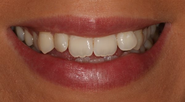 Dream Smile Dental - Invisalign Patient Before