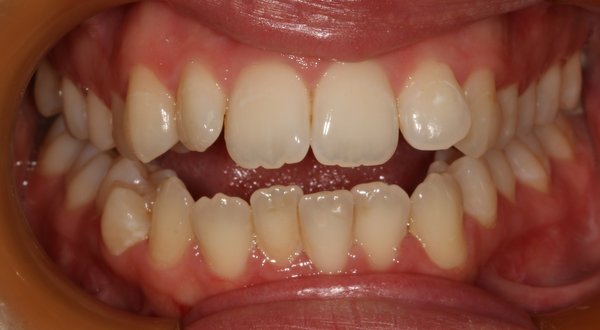 Dream Smile Dental - Invisalign Patient Before
