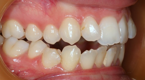 Dream Smile Dental - Invisalign Patient Before