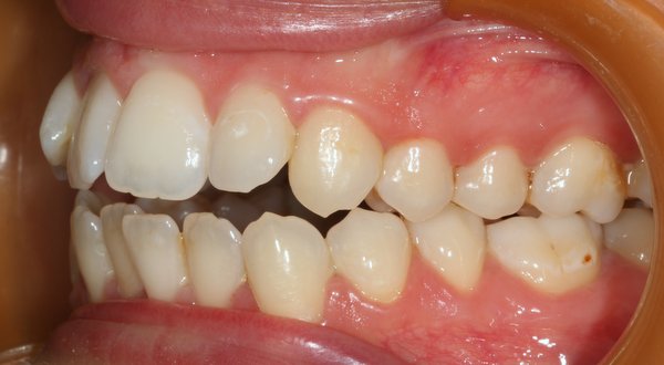 Dream Smile Dental - Invisalign Patient Before