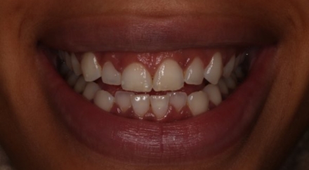 Dream Smile Dental - Laser Gum Contouring / Composite bonding Patient Before